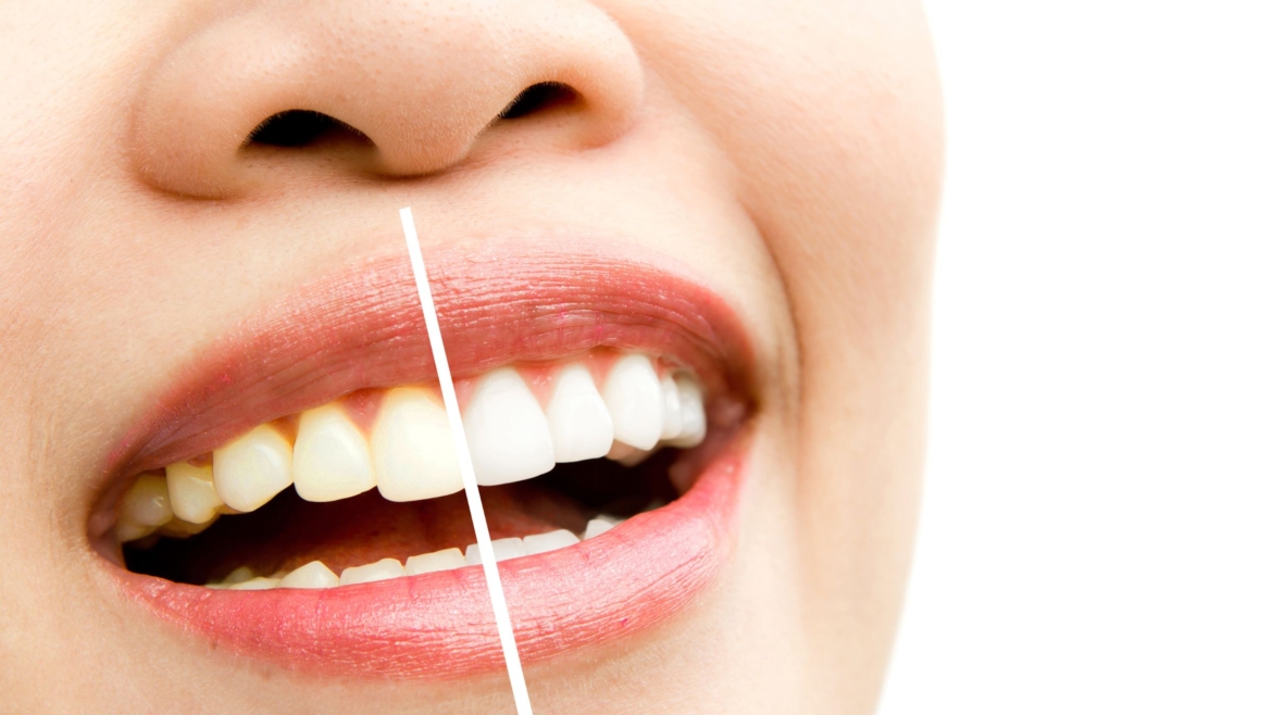 Sbiancamento dentale