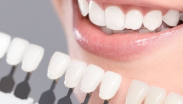 Denti bianchi – Natura o sbiancamento?