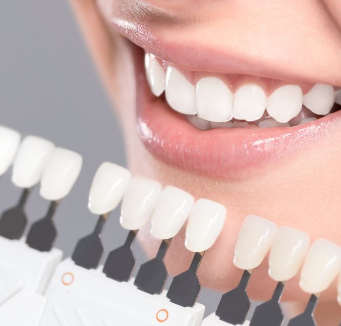 Denti bianchi – Natura o sbiancamento?